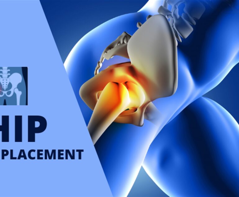 hip replacement surgeon in delhi