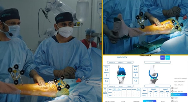 Robotic Knee Replacement Surgeon in Delhi - Dr. Saksham Mittal