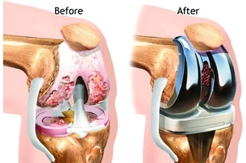 ACL ligament injuries, symptoms, causes, diagnosis, treatment and ACL reconstruction option